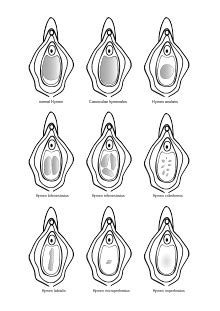 Hymen – Wikipedia.